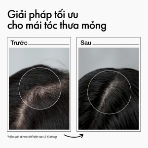 Xịt dưỡng mọc tóc Glatika Hair Technique Density 2X minisize 50ml với Baicapil 3% giúp giảm rụng và kích thích tóc mọc chắc khỏe