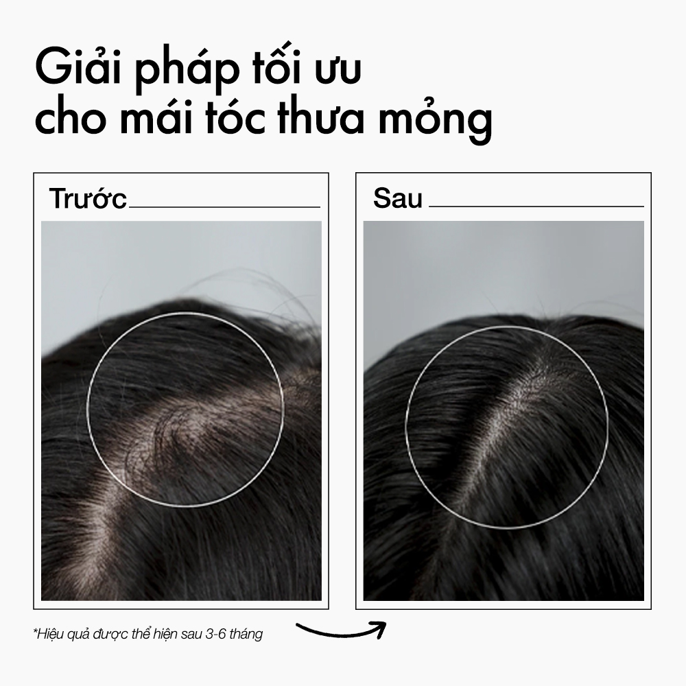 Xịt dưỡng mọc tóc Glatika Hair Technique Density 2X minisize 50ml với Baicapil 3% giúp giảm rụng và kích thích tóc mọc chắc khỏe