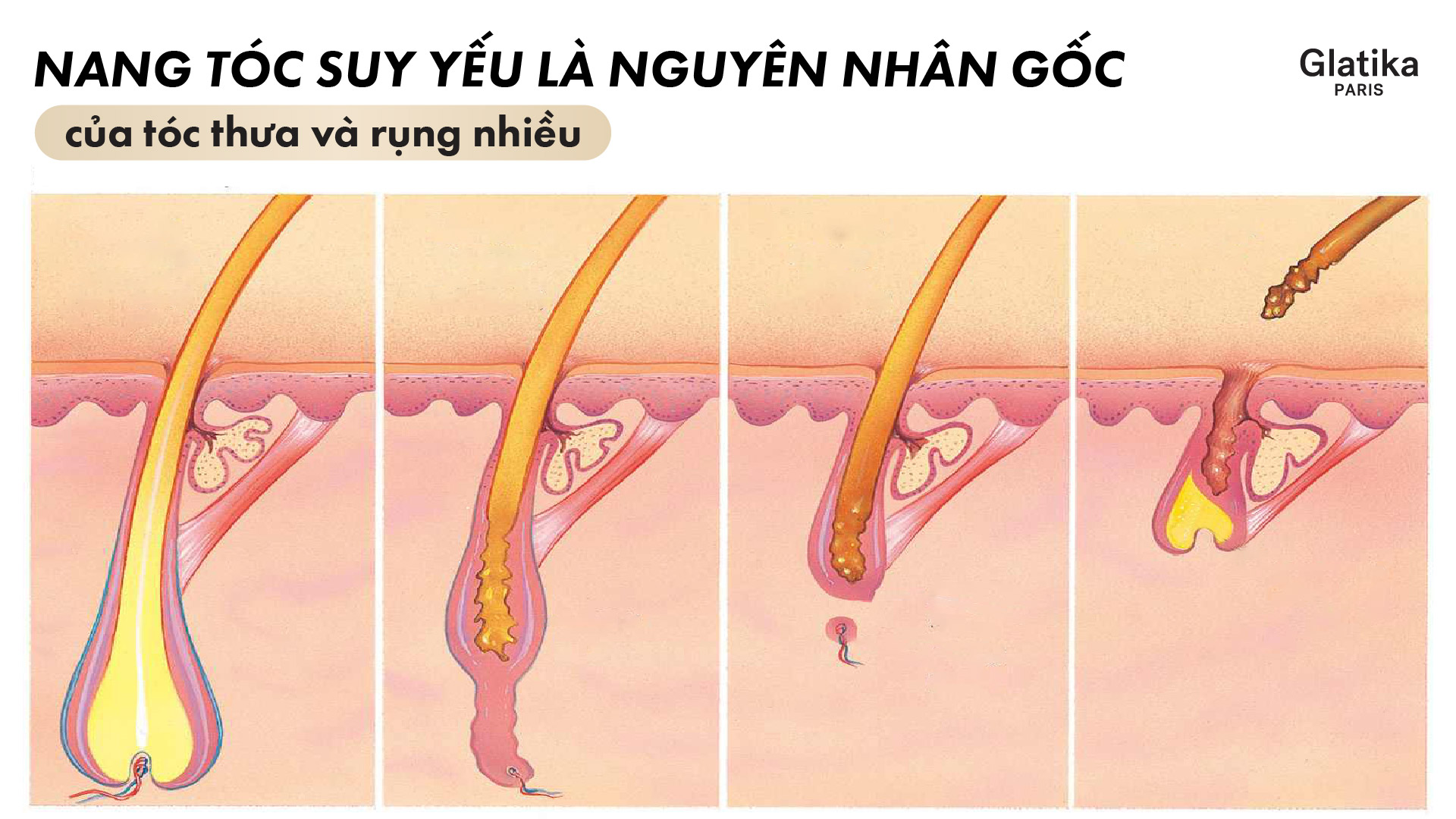 Nang tóc suy yếu là nguyên nhân gốc của tóc thưa và rụng nhiều